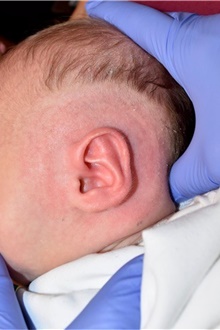 Ear Surgery After Photo by Rachel Ruotolo, MD; Garden City, NY - Case 44949