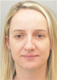 Rhinoplasty Before Photo by Keshav Magge, MD; Bethesda, MD - Case 38569