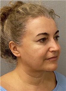Facelift Before Photo by Keshav Magge, MD; Bethesda, MD - Case 49661 Facelift Before Photo by Keshav Magge, MD; Bethesda, MD - Case 49661
