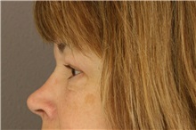 Eyelid Surgery After Photo by Meegan Gruber, MD, PhD; Tampa, FL - Case 8903