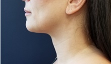 Liposuction After Photo by Noel Natoli, MD, FACS; East Hills, NY - Case 43327