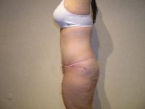 Body Contouring After Photo by Joseph Fodero, MD; Florham Park, NJ - Case 9123